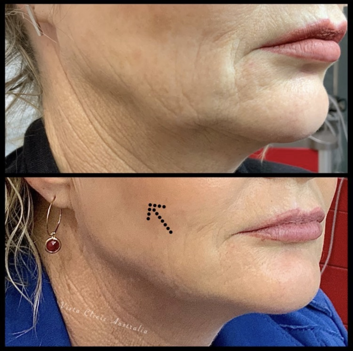 PDO thread lift Vista Clinic Melbourne Australia