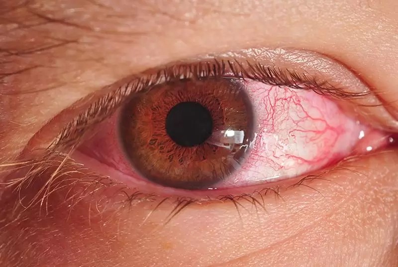 Redness In Eye After LASIK Eye Surgery Visual Aids Centre