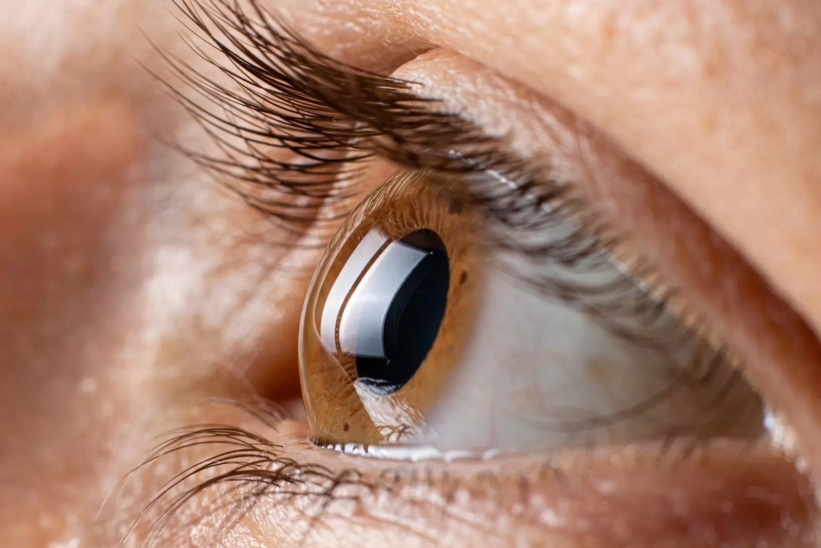 Does Lasik Surgery Cause Keratoconus? Visual Aids Centre