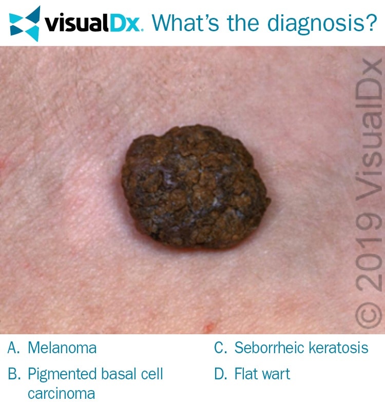 Woman Worried About Dark Brown, Scaly Skin Spots - Let's Diagnose | Visualdx