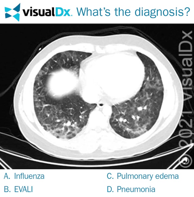 CT Shows Ground Glass Opacities in Man’s Lungs Let’s Diagnose