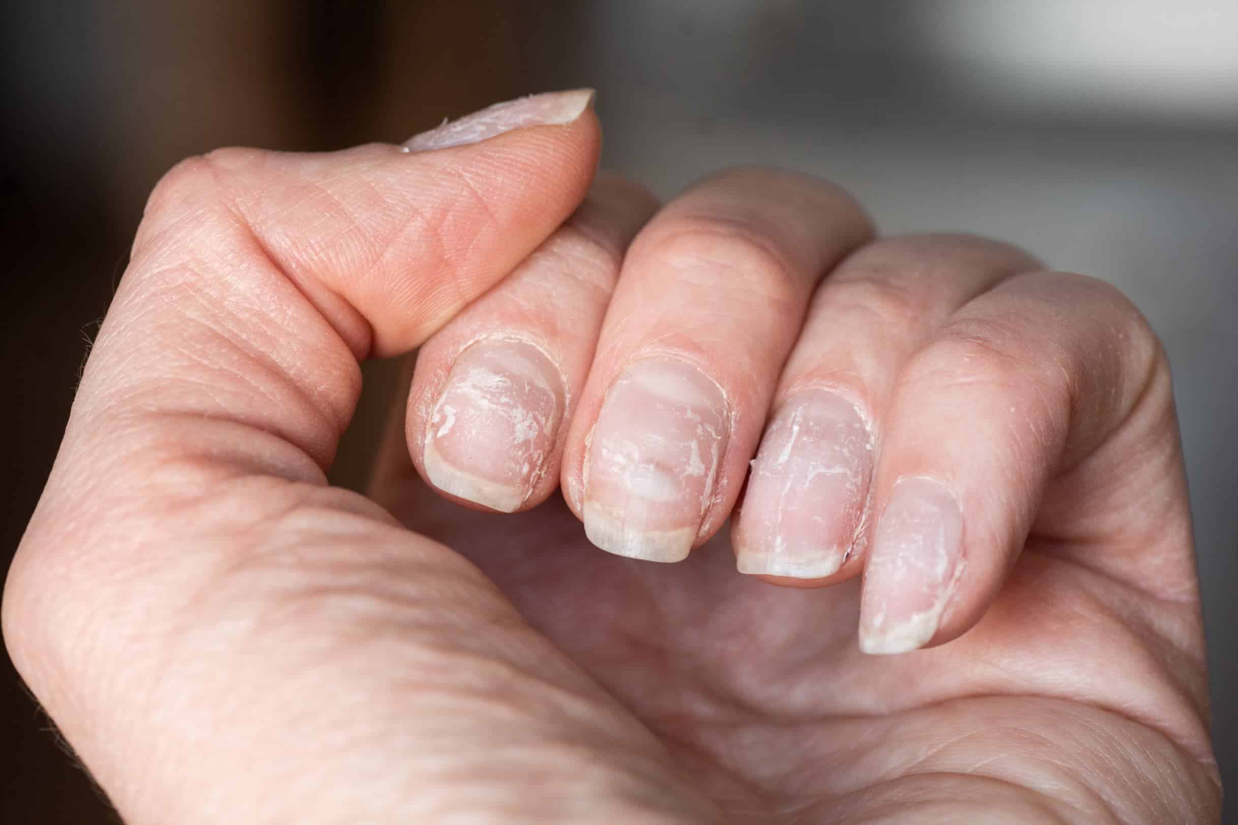 Nail Health When to Schedule an Appointment VitalSkin Dermatology