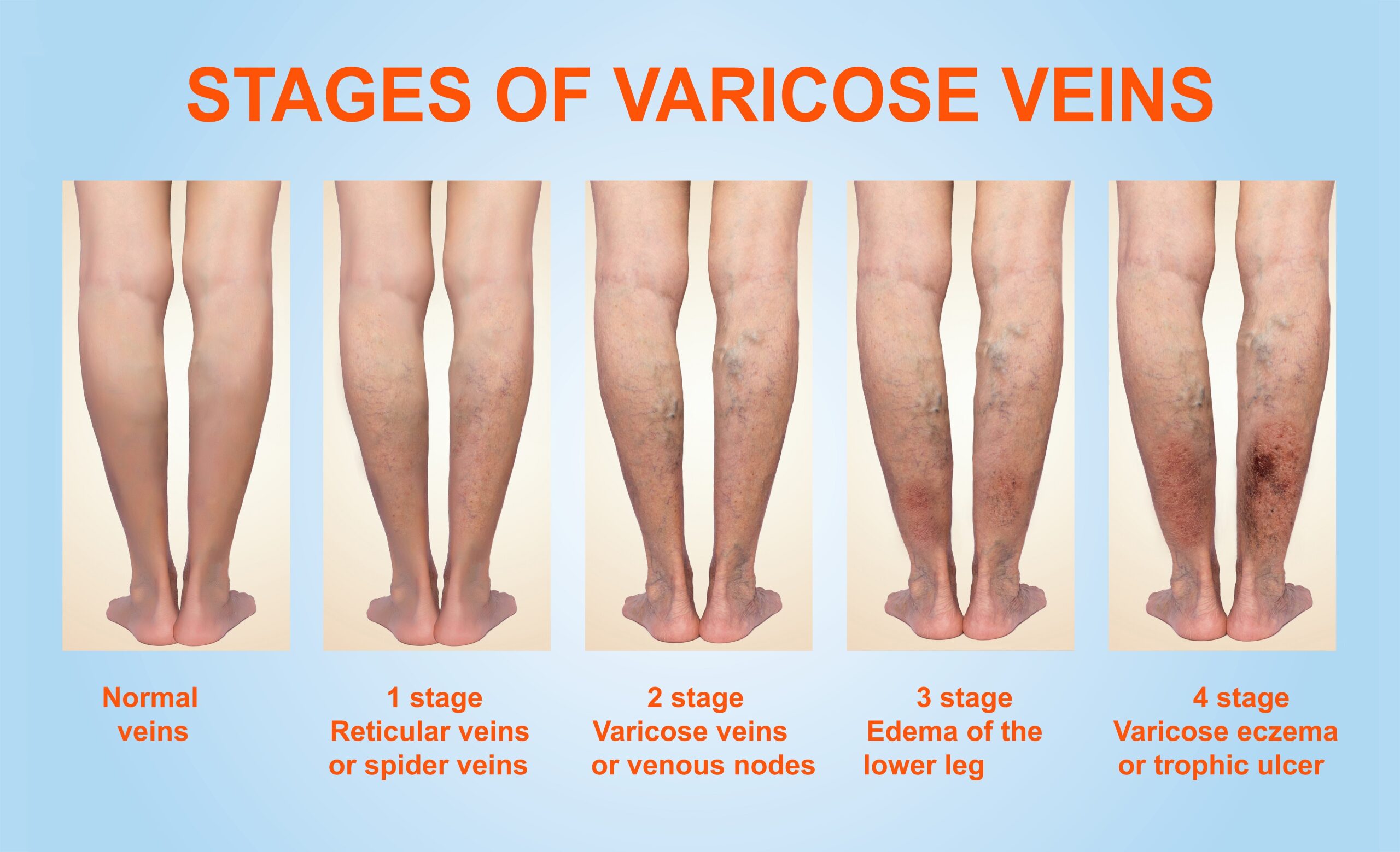 What Are the Stages of Vein Disease? Vantage