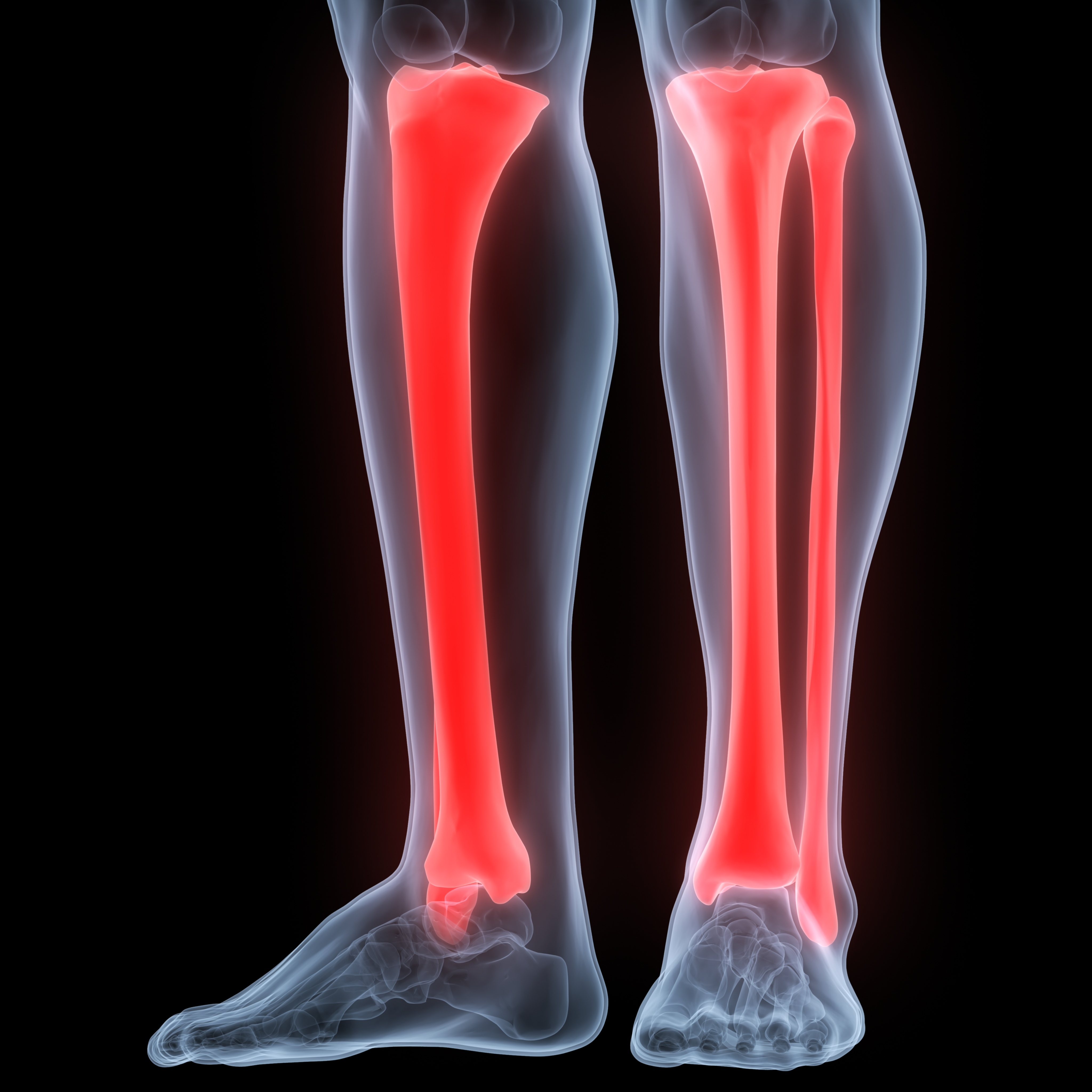 Tibial Fracture after Accident The Vrana Law Firm