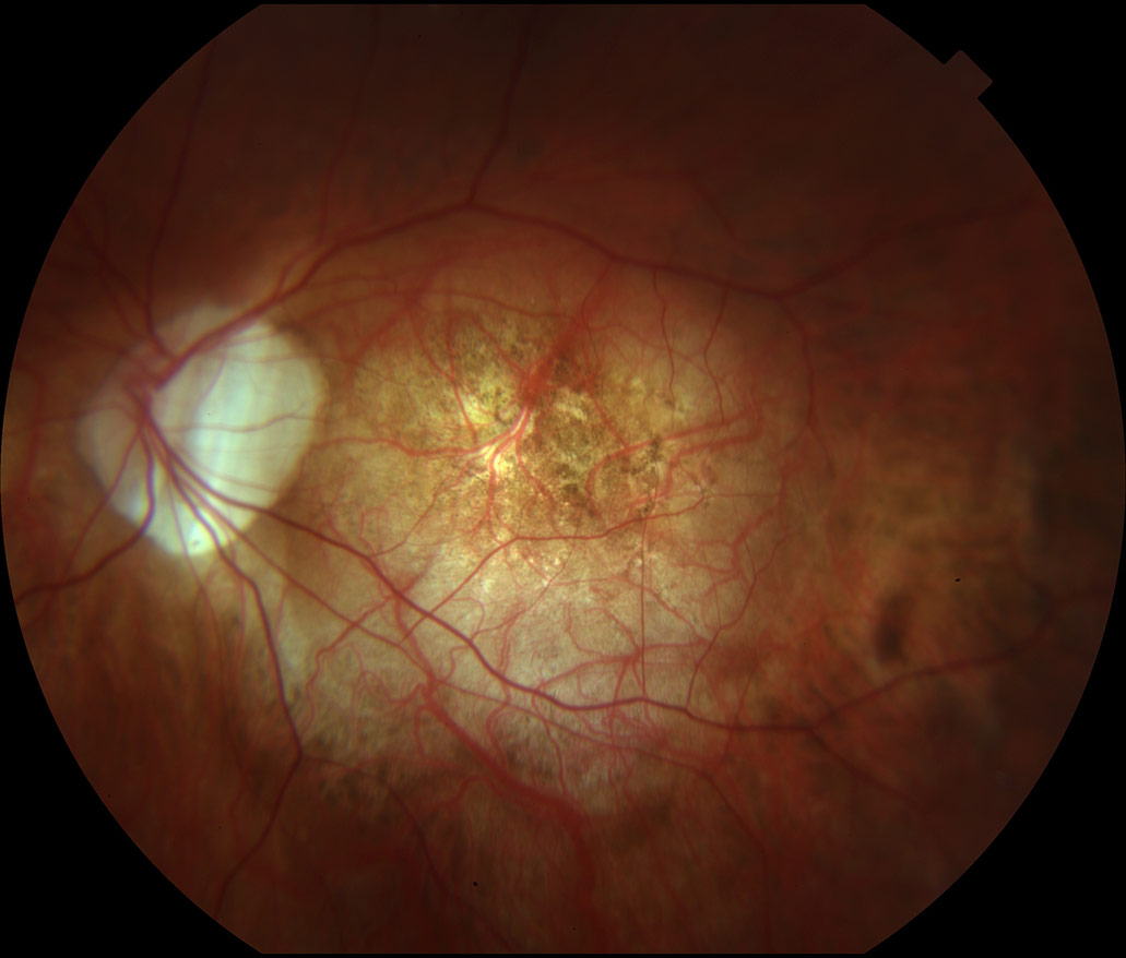 Myopic Degeneration Vitreous Retina Macula Consultants of New York