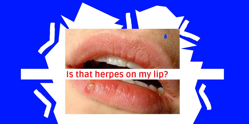 Is that herpes on my lip? Herpes Blood Test