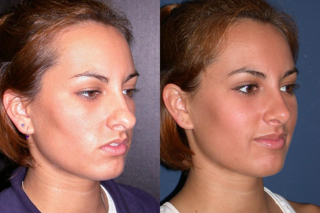 Plastic Surgery Patients From Monroe, LA The Wall Center for Plastic Surgery