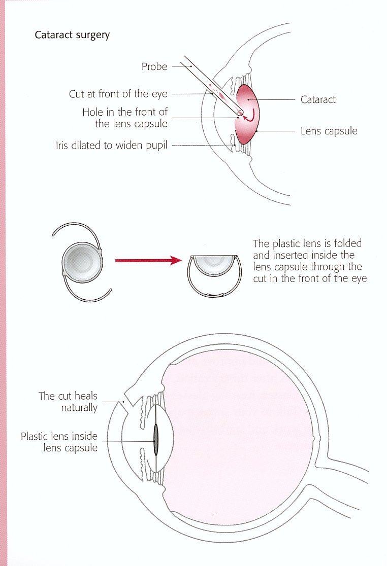 Cataract Removal Surgery Stitches
