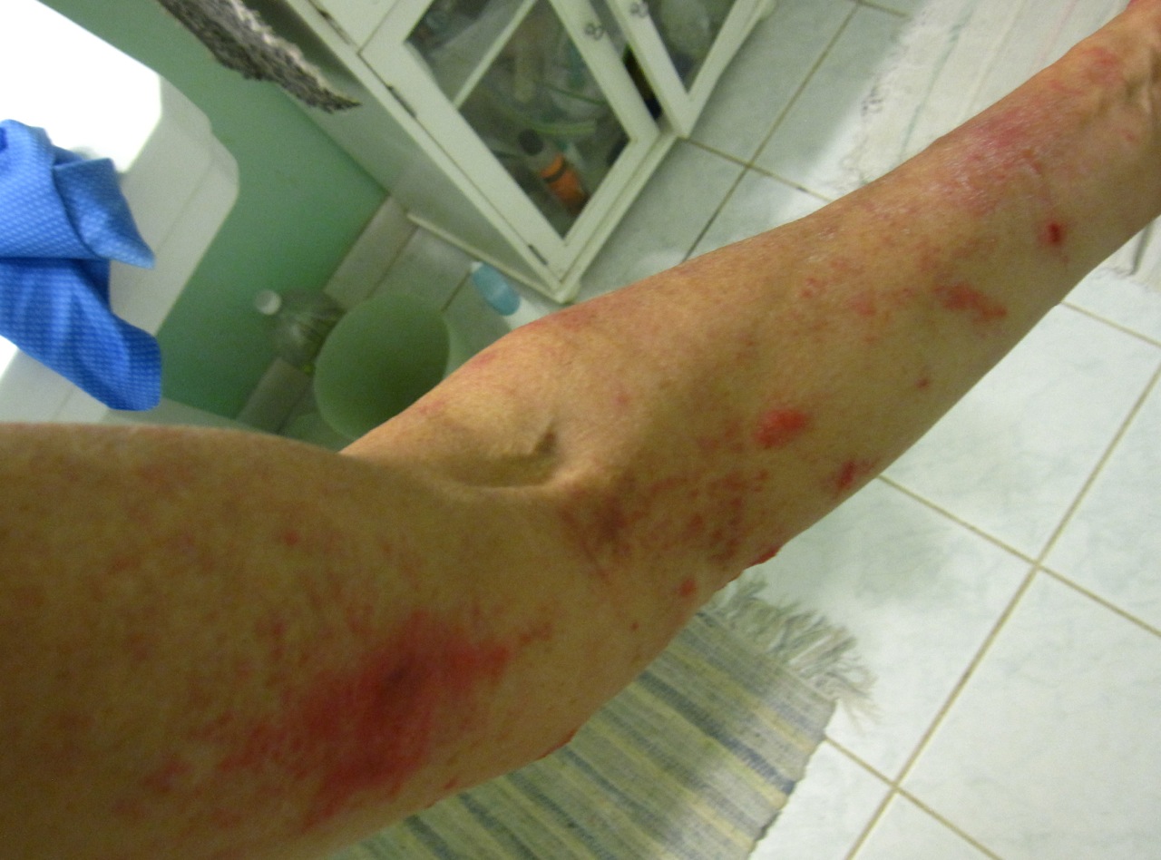 Passionvine Dermatitis (skin rash) Walter Reeves The Gardener