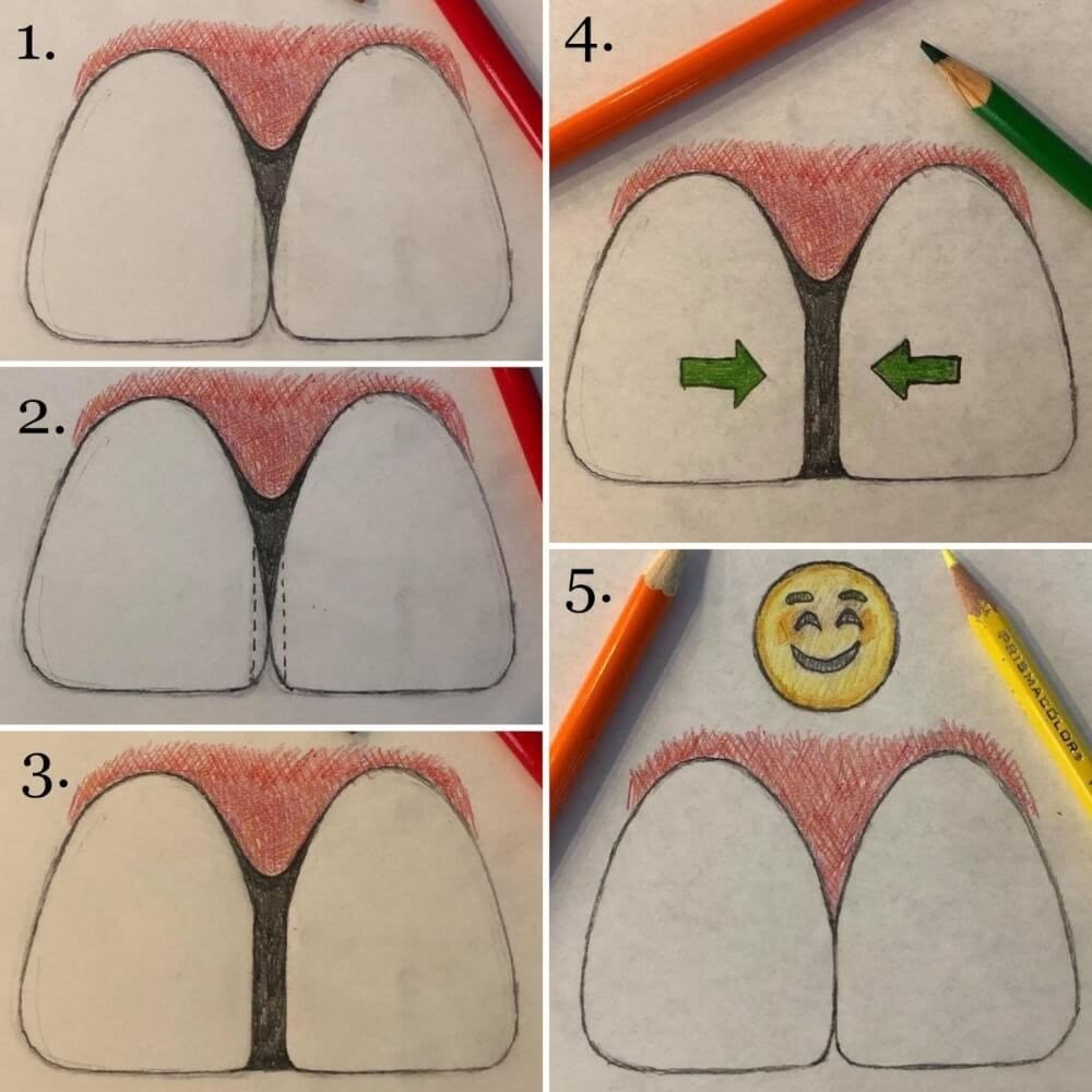 Understanding Interproximal Reduction [FAQ]