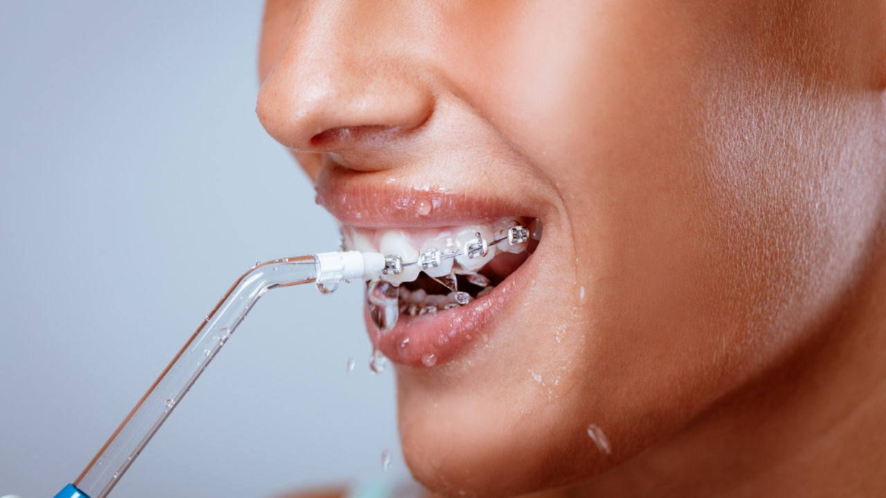 Is A Waterpik As Good As Flossing? Orthodontist Vaughan, Braces