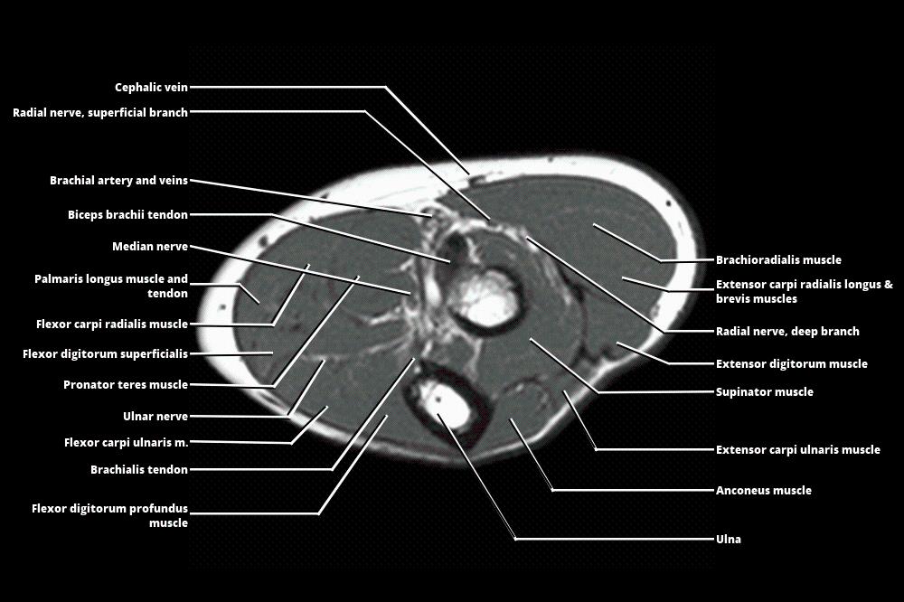 Forearm Muscle Anatomy MRI