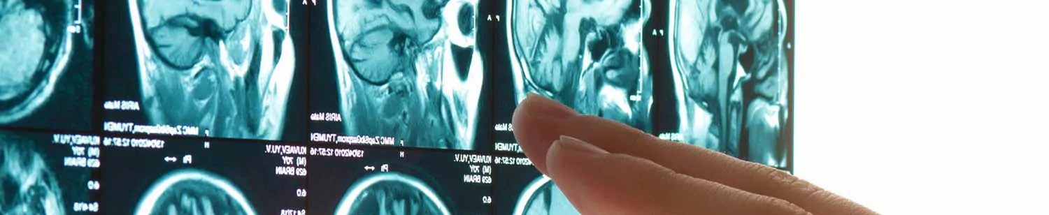 Philadelphia Brain Injury Lawyer Free Consultation Wapner Newman