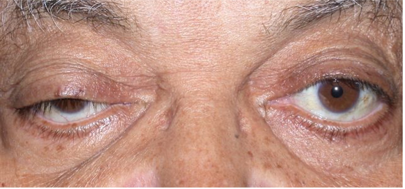 Horner’s Syndrome Warwar Eye Group