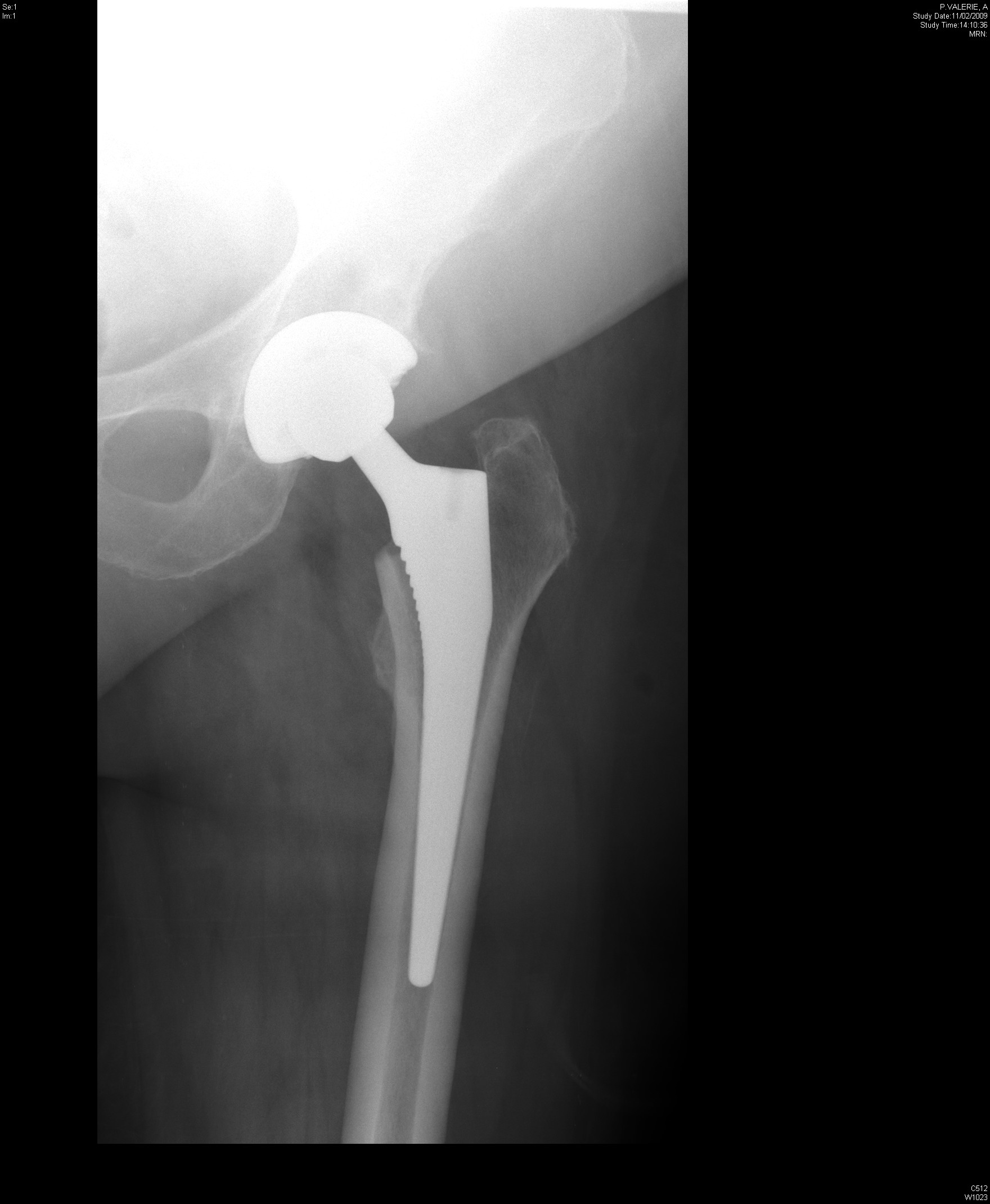 Complications of Total Hip Replacement Surgery/Total Hip Arthroplasty