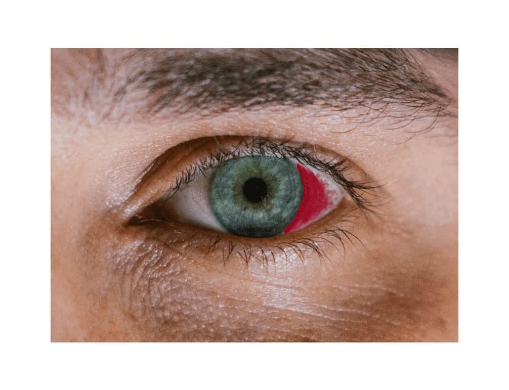 Subconjunctival Hemorrhage er Vision Care