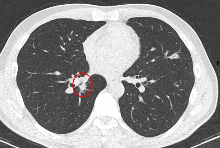 How to interpret CT scans of your lung