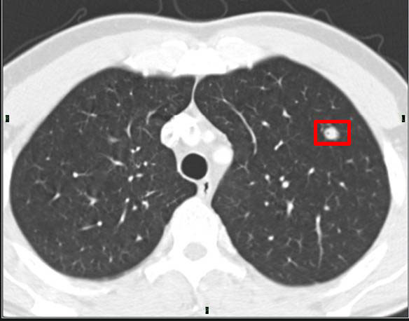 Thorax Ct : How To Interpret Ct Scans Of Your Lung