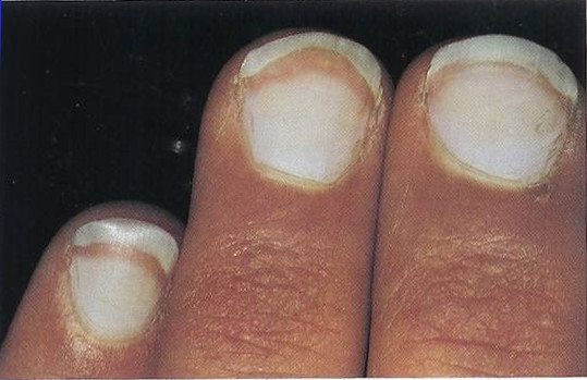 15 Health WARNINGS Your Fingernails Are Sending