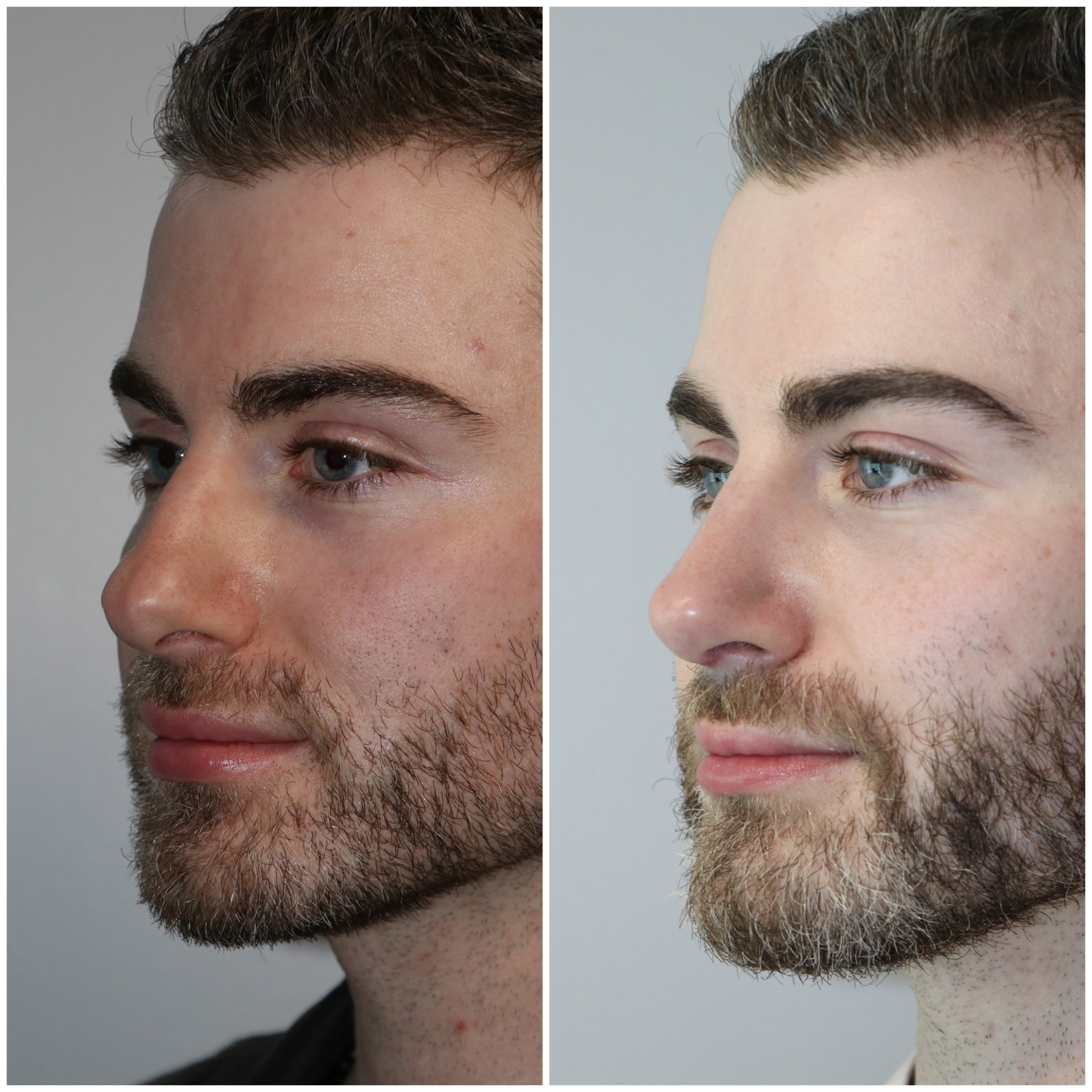 Crooked Nose Repair Westside Face