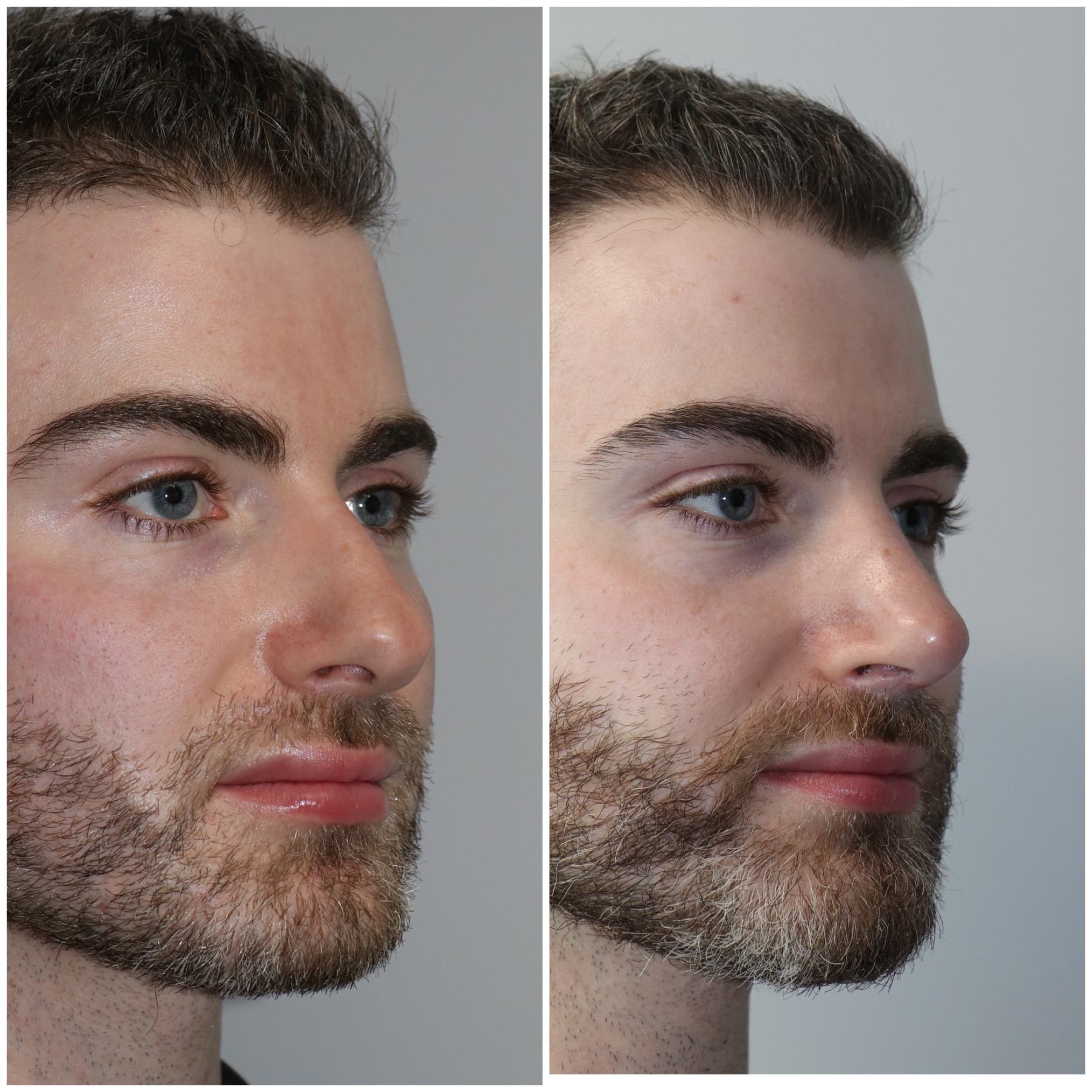 Crooked Nose Repair Westside Face