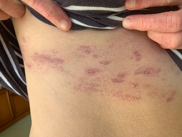 Why have I got shingles? What Allergy Blog