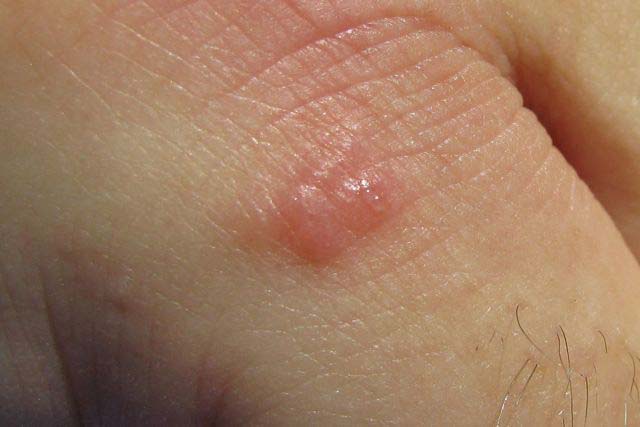 False Bombardier Beetle Is it connected to Sores???? What's That Bug?