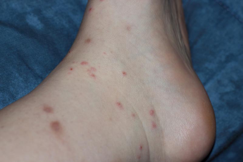 Ticks Archives Page 4 of 8 What's That Bug?