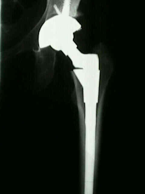 Srom Hip System Wheeless Textbook Of Orthopaedics
