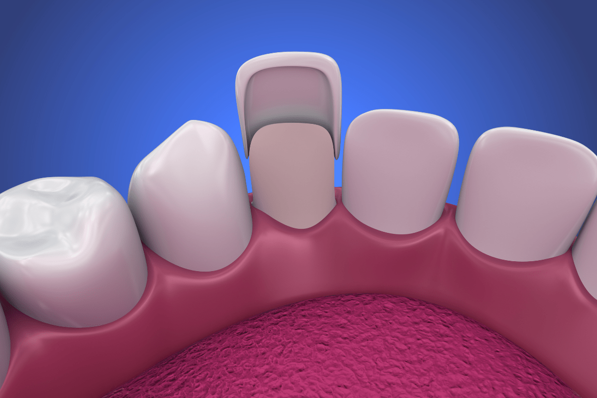 What To Expect From Composite Veneers Malaysia ? White Density