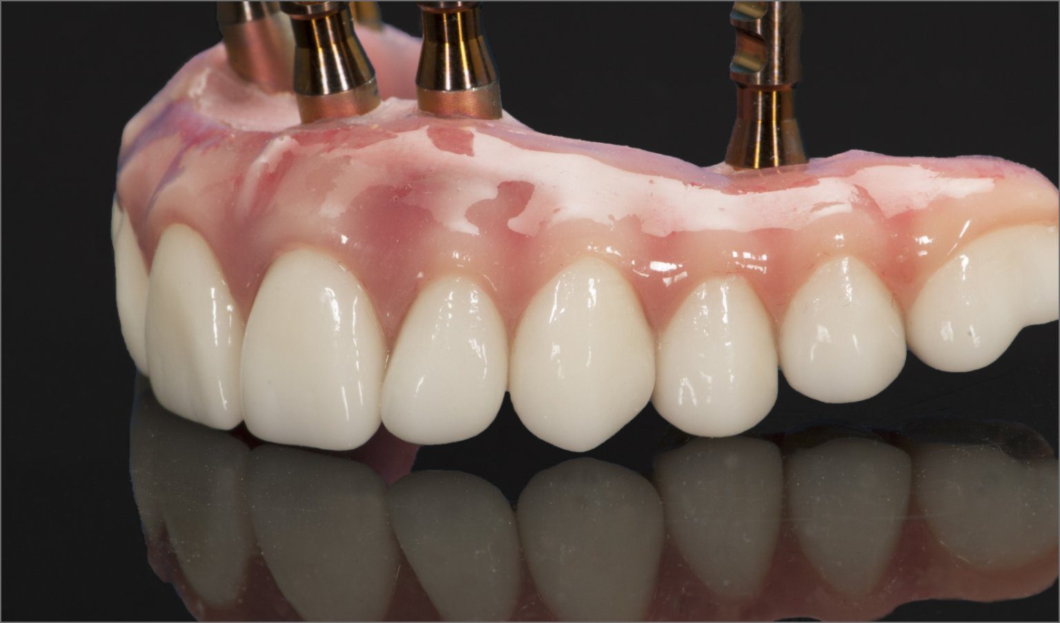 AllonX Dental Implant Lab Wiand Dental Lab Implants & Dentures