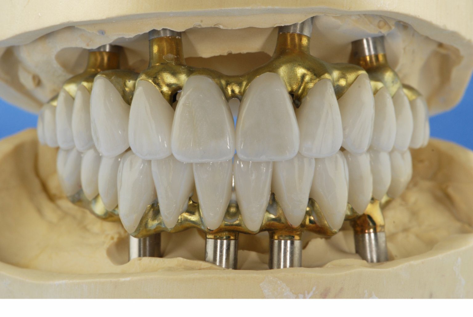 Arizona Denture Labs Implant Supported Denture Restorations