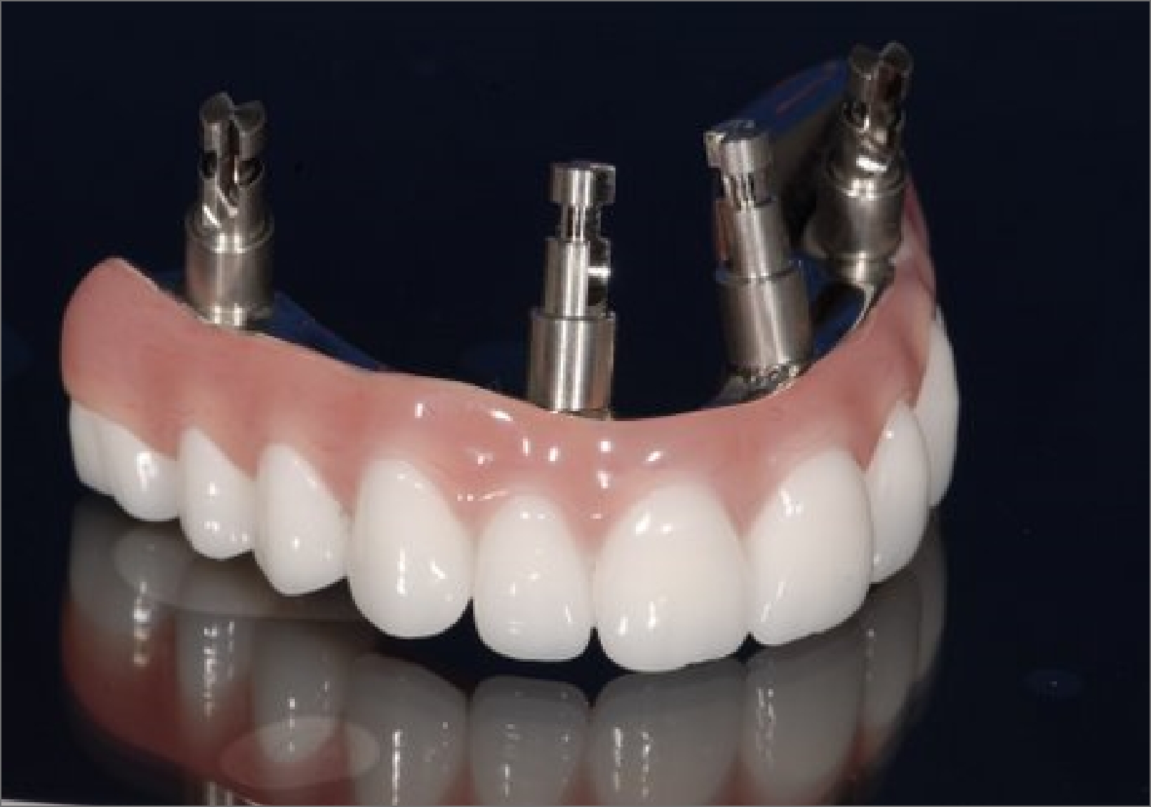 Arizona Denture Labs Implant Supported Denture Restorations