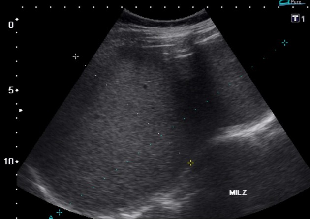Splenic marginal zone lymphoma ultrasound wikidoc