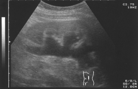 Hydronephrosis wikidoc