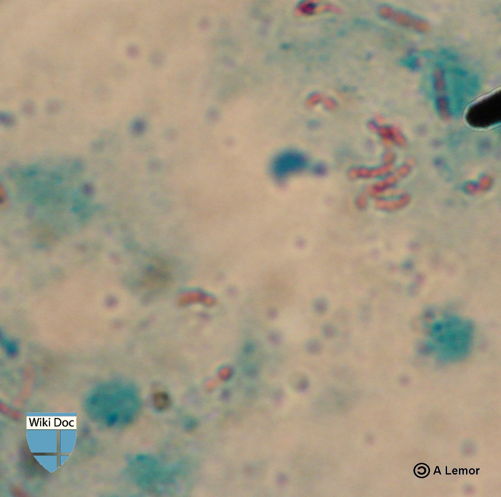 Tuberculosis laboratory findings wikidoc