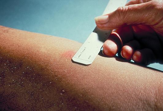 Tuberculosis screening wikidoc