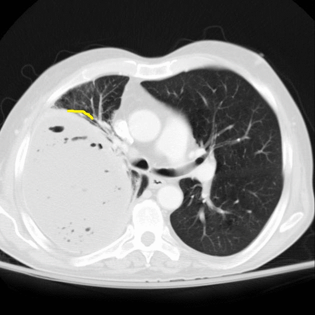 Pleural empyema CT wikidoc