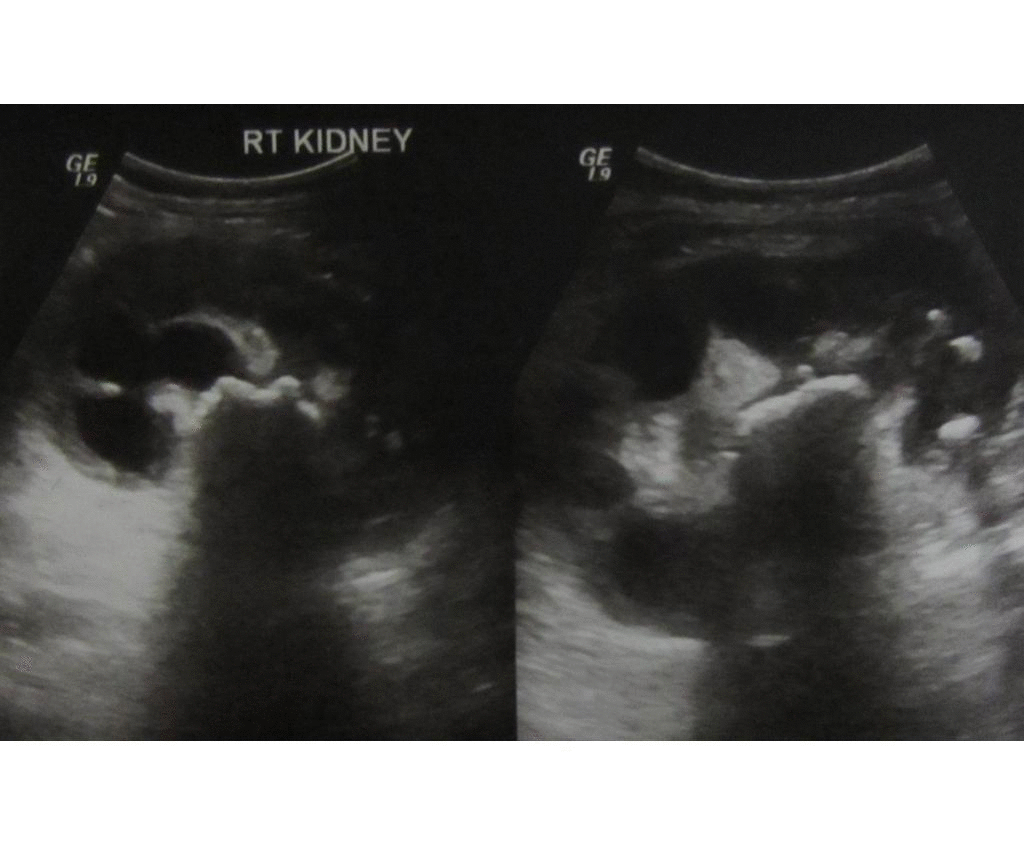 Pyelonephritis echocardiography and ultrasound wikidoc