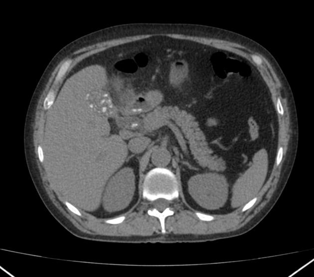 Choledocholithiasis CT wikidoc