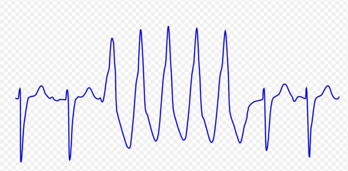 Pulseless ventricular tachycardia differential diagnosis wikidoc