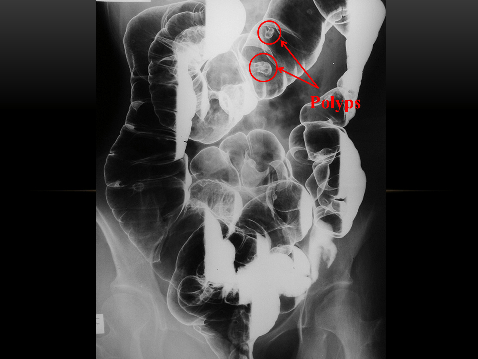 PeutzJeghers syndrome CT wikidoc