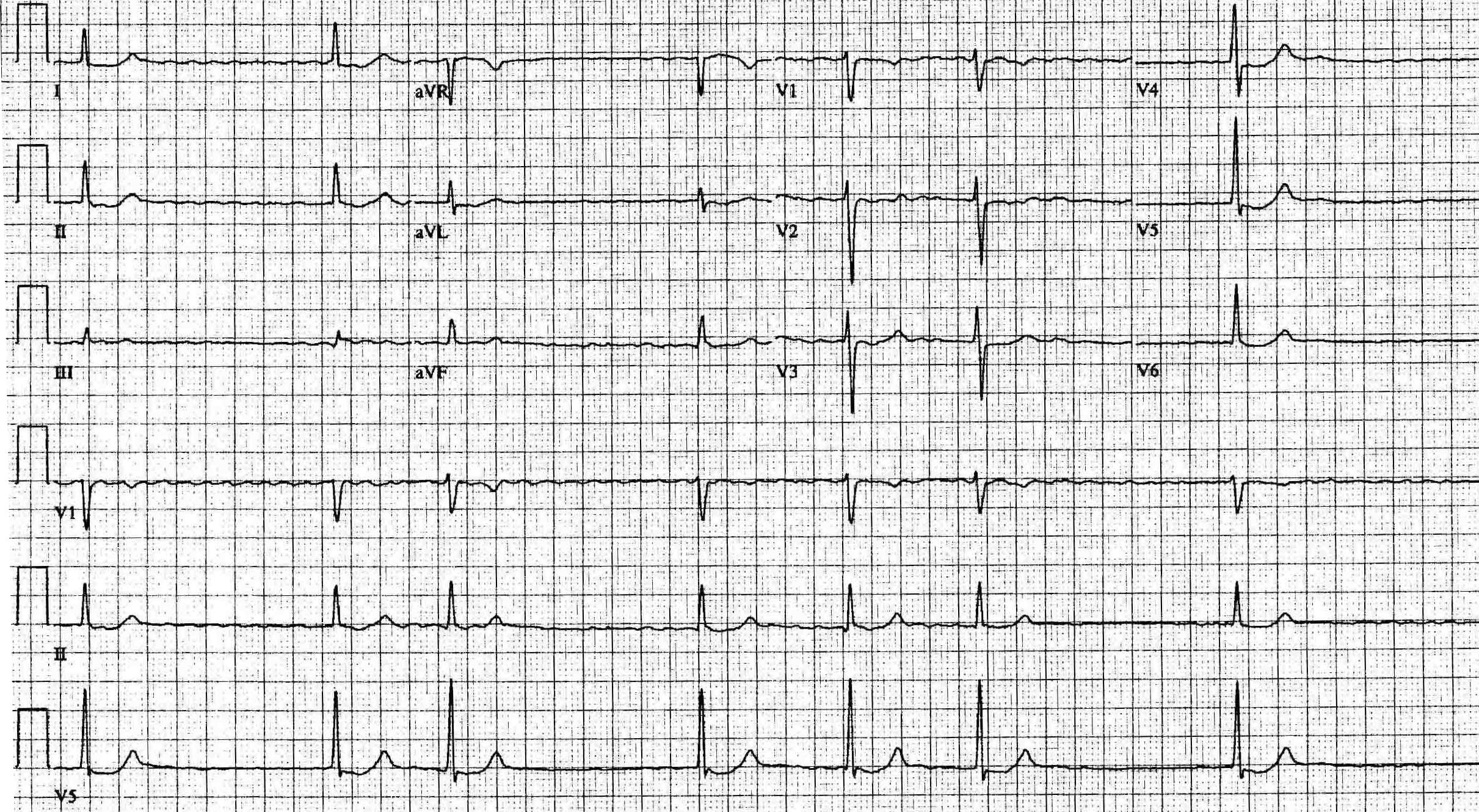 The EKG in the patient treated with digitalis wikidoc