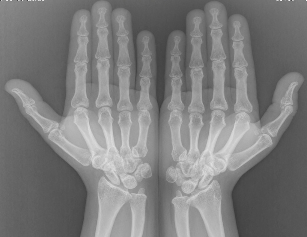 Turner syndrome x ray wikidoc