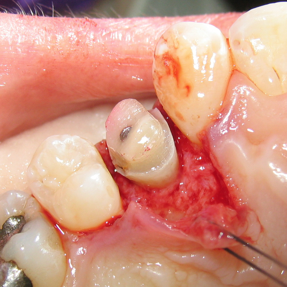 Crown (dentistry) wikidoc