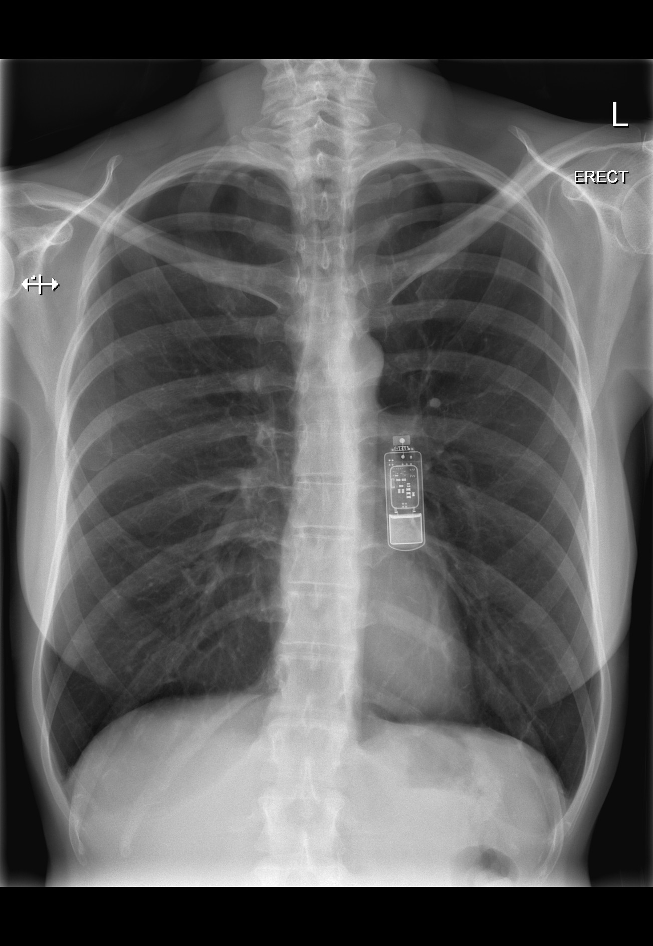 Syncope x ray wikidoc