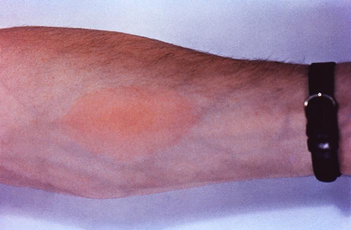 Coccidioidomycosis physical examination wikidoc