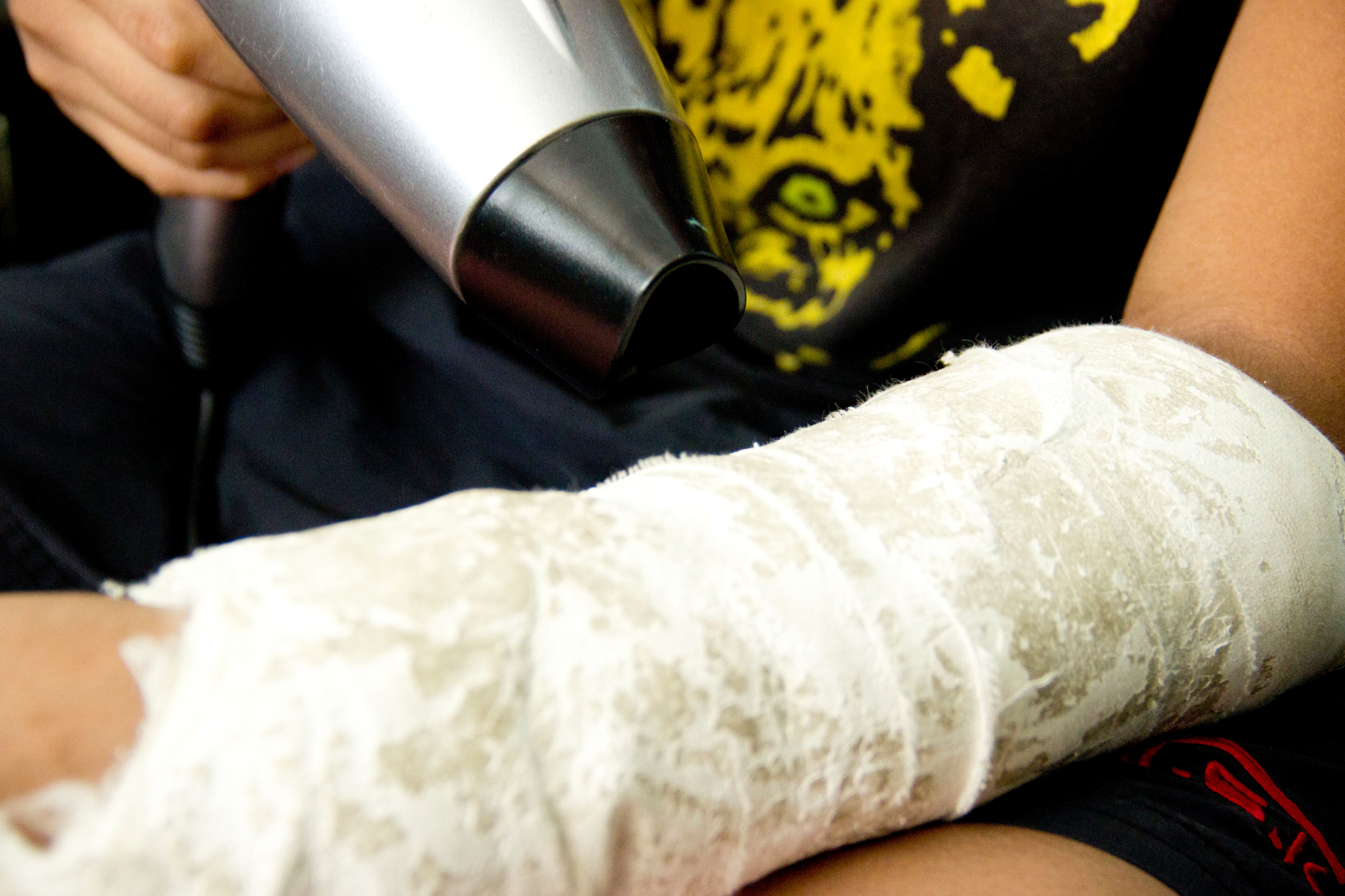 How to Scratch Under Your Cast 4 Steps (with Pictures)