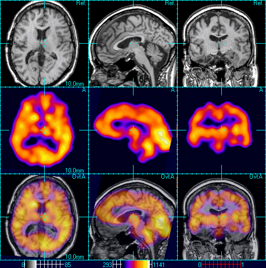 SINGLEPHOTON EMISSION COMPUTED TOMOGRAPHY (SPECT) WikiLectures