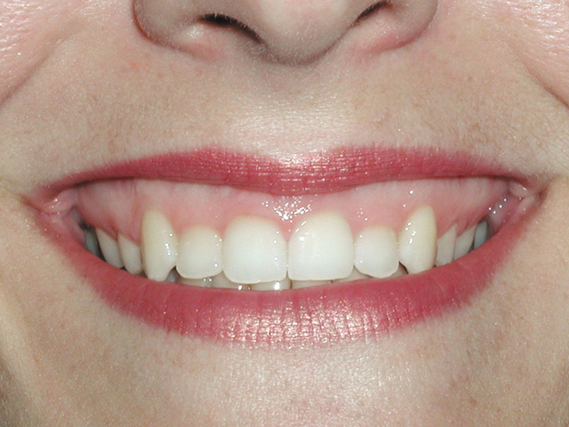 Gummy Smile Improvement Austin Dentist Mike Williamson DDS MS